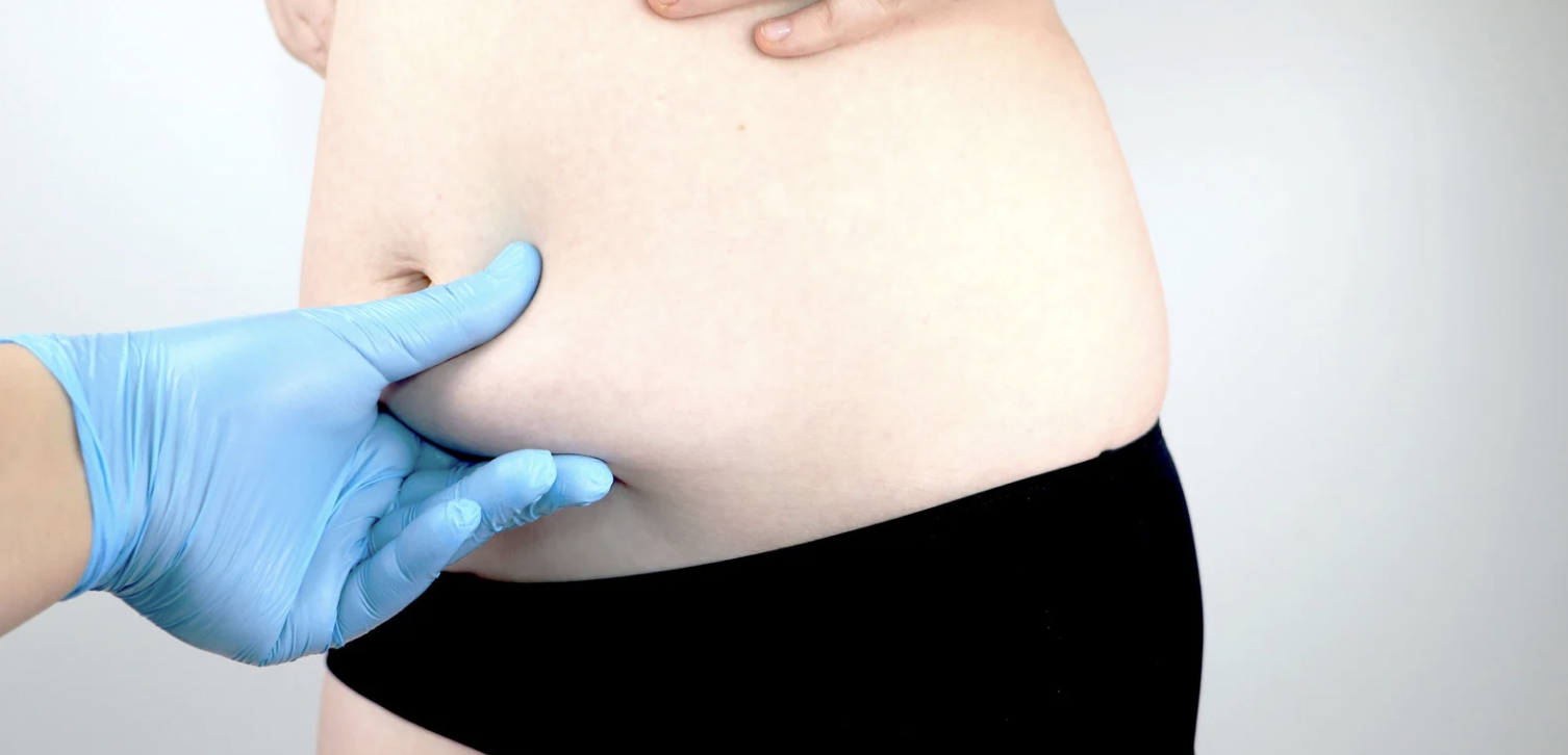 Liposuction Results Near Alexandria Virginia